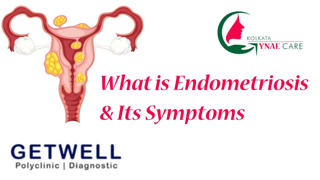 What is Endometriosis and Its Symptoms